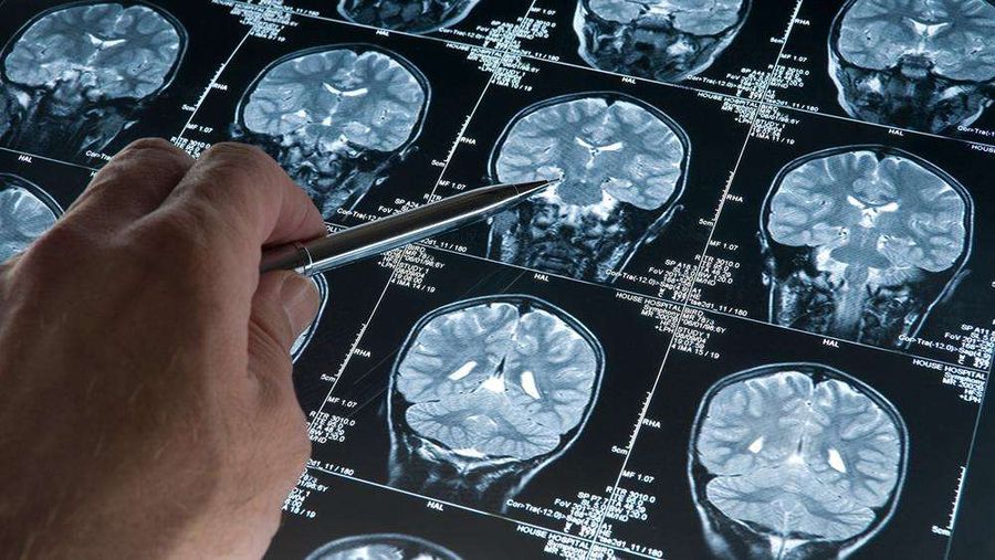 Alzheimer, ölümcül hastalık olmaktan çıkıyor Alzheimer, ölümcül hastalık olmaktan çıkıyor