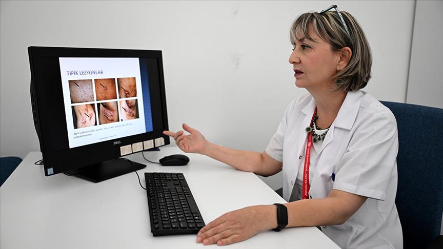 Derideki ağrılı nodüller ‘hidradenitis süpürativa’ belirtisi olabilir Derideki ağrılı nodüller ‘hidradenitis süpürativa’ belirtisi olabilir