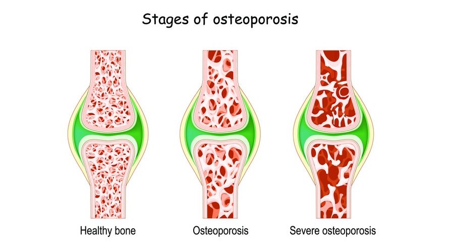 Erkeklerde osteoporoz gittikçe yaygınlaşıyor Erkeklerde osteoporoz gittikçe yaygınlaşıyor