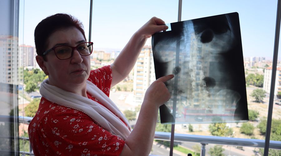 22 yıldır karnında ameliyat iğnesiyle yaşıyor 22 yıldır karnında ameliyat iğnesiyle yaşıyor