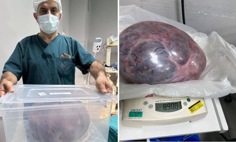 Yumurtalıklarındaki 9 kiloluk kitle operasyonla çıkarıldı