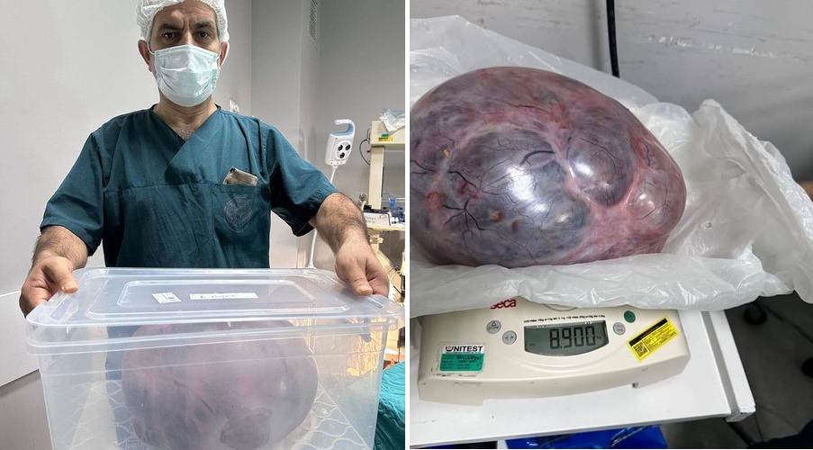 Yumurtalıklarındaki 9 kiloluk kitle operasyonla çıkarıldı Yumurtalıklarındaki 9 kiloluk kitle operasyonla çıkarıldı