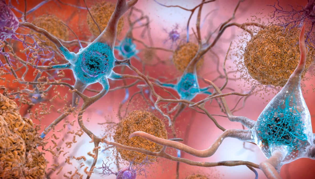 Araştırmacılardan Alzheimer’a karşı yeni yöntem: SHIELD nedir? Araştırmacılardan Alzheimer’a karşı yeni yöntem: SHIELD nedir?
