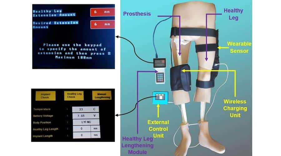 Türk akademisyenler, kemik kanseri tedavisi için tümör protezi geliştirdi