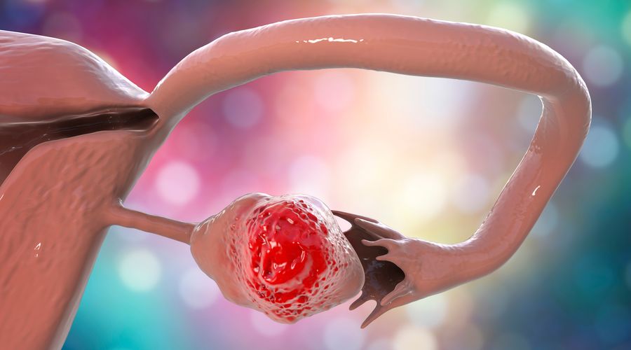 Yumurtalık kanseri riskini ölçen algoritma geliştirildi: Cerrahi menopozu öteleyebilir