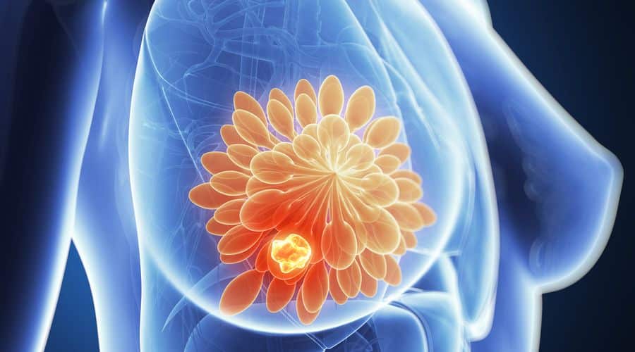 Metastatik Meme Kanseri Tedavisinde Yeni Gelişmeler